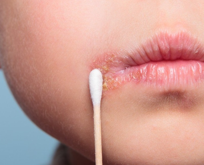 Eliminación de verrugas por herpes